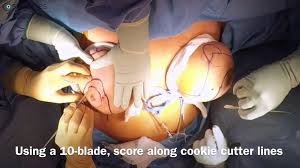 Breast Reduction In Lethbridge, Alberta | Lethbridge Plastic Surgery
