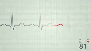 Animation Of Schematic Diagram Of Normal Sinus Rhythm For A 17a231_448