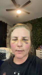 Can you tell I still have a broke nose ? #fypage #softball #brokenose  #makeuphacks #fyp