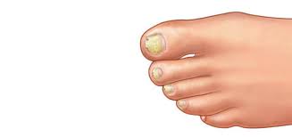 Puffiness da almofada de unhas, a formação de escamas prateadas sobre ele, o. Onicogrifose Ou Unha Grossa Tem Tratamento