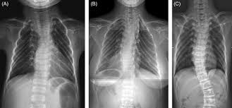 41 фраза в 14 тематиках. Thorax Deformity An Overview Sciencedirect Topics