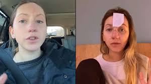 Mulher que teve nariz arrancado por cachorro compartilha resultado após 16  cirurgias