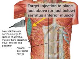 The intercostal muscles can become strained due to very rapid movements or twisting of the torso. Pecs Serratus Highland Em Ultrasound Fueled Pain Management