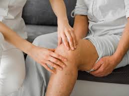 Image result for Calciphylaxis