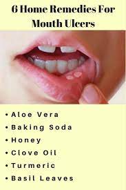 Six Home Remedies For Mouth Ulcers Mouth Ulcers Home Remedies For Mouth Ulcers Ulcer Remedies Mouth