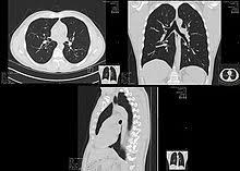 Helical, or spiral, computed tomography (ct) is, by its very nature, a volumetric acquisition method. High Resolution Computed Tomography Wikipedia