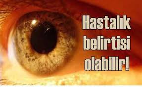 Acik Goz Renginde Sari Nokta Hastaligi Riski Daha Fazla Goz Rengi Nokta Kan Damarlari