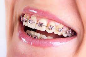 In mexico braces cost goes from $500 usd to $4500 usd it all depends on the type of braces. Sheap How Much On Twitter How Much Do Braces Cost In Mexico Https T Co Fkjdjqfvx1 Braces Buckteeth Orthodontics Healt Mexico
