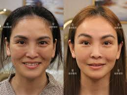 皇妍分享204～臉型的幼態感很多客人在諮詢時，都會詢問臉部如何能呈現幼態感？ 臉部幼態感的改變，不外乎是： 動、靜態紋路少一點