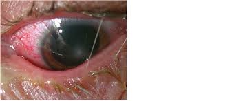 Keratitis is a condition where the cornea becomes inflamed or swollen. Racgp Management Of Microbial Keratitis In General Practice