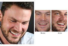 How to fix a small gap in your teeth. Close A Gap In Front Teeth How To Fix Gap Teeth