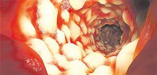 Bei der colitis, die sich am stück vor allem im dickdarm ausbreitet, haben die patienten häufig blut im stuhl. Marker Im Stuhl Geben Aufschluss Uber Krankheitsverlauf
