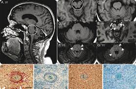 Перевод статьи evans r.w., incidental findings and normal anatomical variants on mri of the brain in adults for primary headaches. Widespread Inflammation In Clippers Syndrome Indicated By Autopsy And Ultra High Field 7t Mri Neurology Neuroimmunology Neuroinflammation