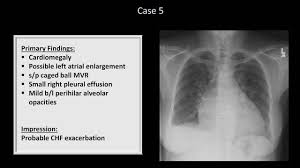Vq mismatch and hyponatremia lectures have been popular. How To Interpret A Chest X Ray Lesson 10 Self Assessment Part 1 Youtube