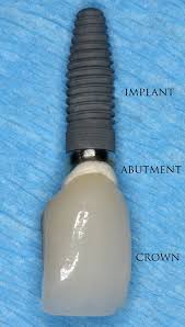 Many people note that if they have small titanium screws they don't set off dental implants are small, and they're made of a metal that is harder to detect, and they're insulated. The Making Of A Dental Implant Engineering360