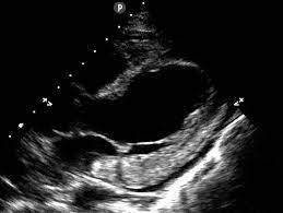 ▪ герпес вирус 6 типа. Fulminant Myocarditis On Pocus Echocardiogram Fulminant Grepmed