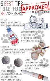 How To Get Rid Of Red Acne Marks. The Best 5 Tips! | Red Acne Marks, Acne  Marks, Cover Up Pimples