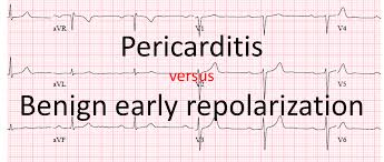 Image result for Early Repolarization