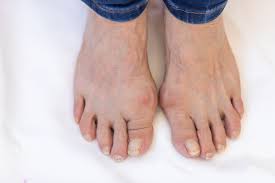 Image result for gout symptoms toe