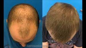 Retain is the key word here: Vitamins Regrow Lost Hair How To Use Olive Oil For Hair Loss Youtube