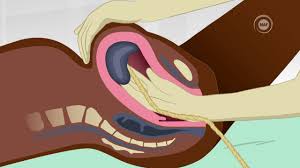 Image result for Retained Placenta