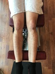 The gemelli muscles are the inferior gemellus muscle and the superior gemellus muscle, two small accessory fasciculi to the tendon of the internal obturator muscle. The Gait Guys