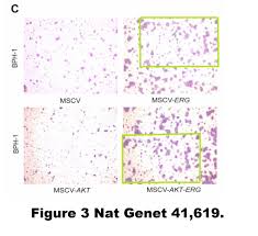 The breast cancer in women center is very firm (scirrhous) and white  histologically, it has the same features as the because of the desmoplasia. The Wizard Men Curing Breast Cancer For Better Science