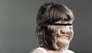 Image result for Hypertrichosis