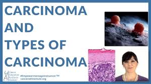 Basal cell carcinoma (bcc) is the most common form of skin cancer and the most frequently occurring form of all cancers. What Is Carcinoma And What Are The Types Of Carcinoma Cancer Ed Res Institute Youtube