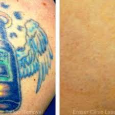 ◄◄ ◄ previous page page 16757 of 19097 next page ► ►►. Removery 100 Photos Tattoo Removal 110 Cypress Station Dr Houston Tx Phone Number Yelp