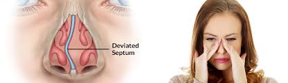 Nasal polypectomy is a surgical procedure that is undertaken to remove nasal polyps. Fess Functional Endoscopic Sinus Surgery Cost In India Medsurge India