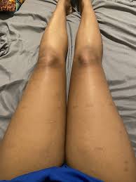 After 6 months with the area totally covered, a gradual suntan with a sun screen lotion with an spf of 15 was prescribed by the dermatologist. Hypopigmentation After Laser Treatment Burns Photo Tips For Skin Care Hairtell Hair Removal Forum By Andrea James