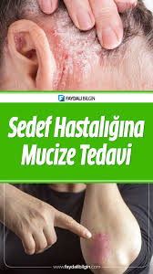 Sedef Hastaligina Mucize Tedavi Faydali Bilgin Saglik Saglik Urunleri Dogal Tedaviler
