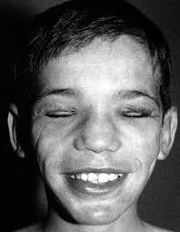 An Unknown Autoinflammatory Syndrome Associated with Short Stature and  Dysmorphic Features in a Young Boy