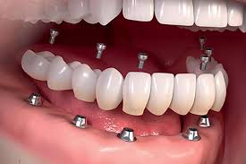 Cel Mai Bun Pret Pentru Clinica Dentara Romana Londra Facebook