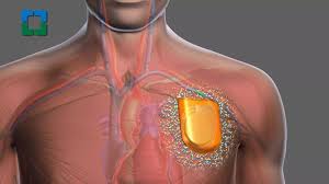 Image result for Cardiac Pacemaker Infection