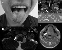 Persistent Idiopathic Unilateral Isolated Hypoglossal Nerve Palsy A Report Of Two Cases The Egyptian Journal Of Neurology Psychiatry And Neurosurgery Full Text
