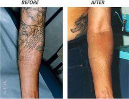 Pin On Tattoo Removal Before And After
