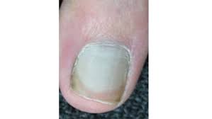 Image result for Beau lines feet