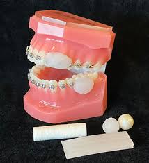 When wearing traditional braces, all those wires inside your mouth can cause you some pain.if wires become loose or undone, they can poke and scratch the inside of your mouth. How To Use The Wax Charles C Low Orthodontics La Canada Ca