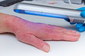 Phototherapy Safe Effective For Psoriasis Dermatology Times And Multimedia Medical Llc