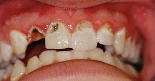 1 zum vorschein, sind die elternfreuden groß. Atemwegserkrankungen Erhohen Kariesrate Bei Bleibenden Zahnen