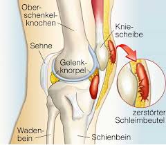 Schleimbeutelentzundung Bursitis Am Kniegelenk Www Gelenk Doktor De