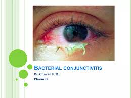 Image result for Bacterial Conjunctivitis