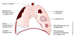 Vann i lungene diagnose vann i lungene oppstår når væske samler seg i lungesekkene, noe som gjør det vanskelig å puste. Pleurapunksjon Nhi No