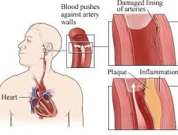 Pin On Exercise For High Blood Pressure