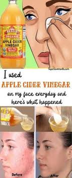 Reasons Why Apple Cider Vinegar Toner Is Getting More Popular In The Past  Decade