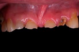 Protese Parcial Fixa Ii Especializar Protese Dental