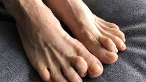 There are two ways to get rid of. Hammertoe Claw Toe Weil4feet