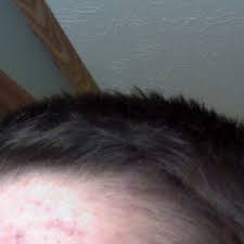 My 15 year old male cat has a similar condition. I M 15 And My Hair Is Thinning Photo